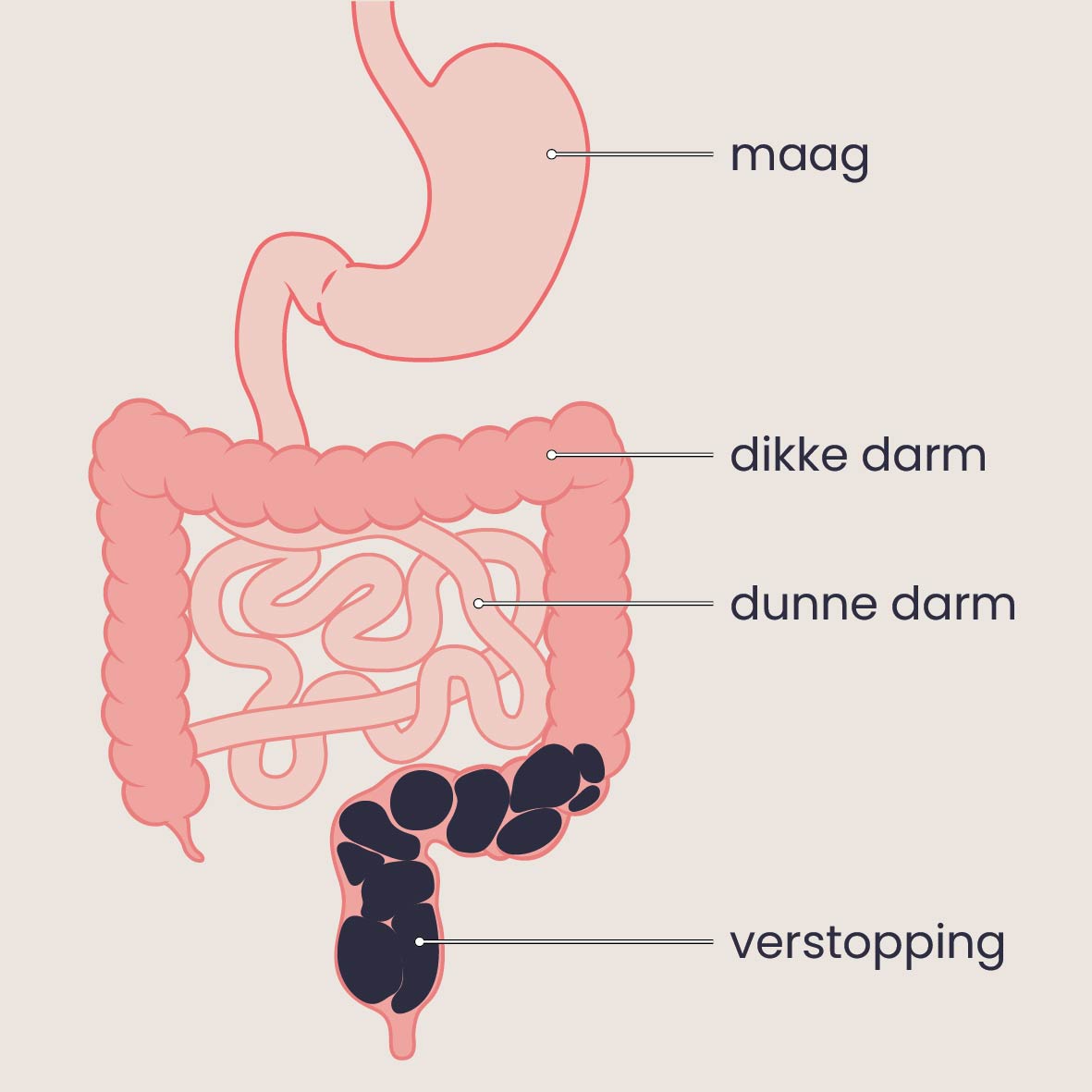 De maag, de dunne darm, de dikke darm en een verstopping 