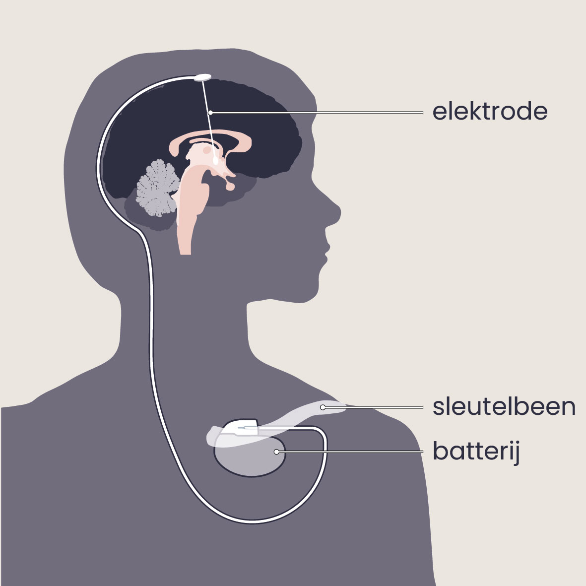 Diepe hersenstimulatie (DBS)