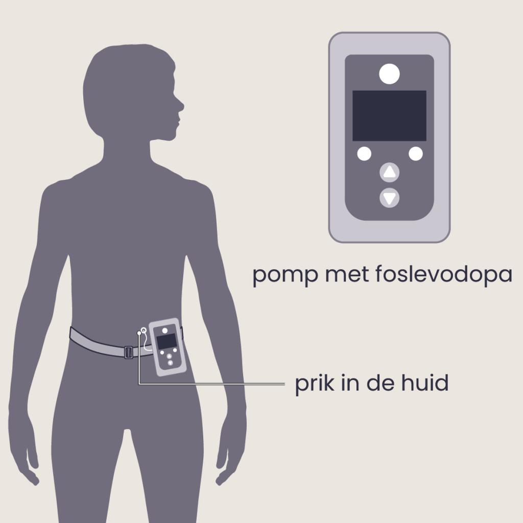 Levodopapomp huid