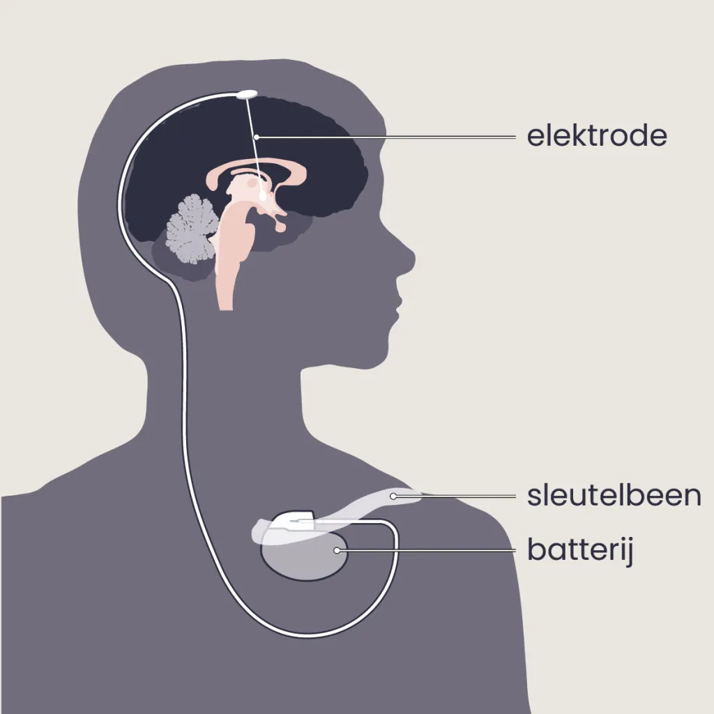 Diepe hersenstimulatie (DBS)